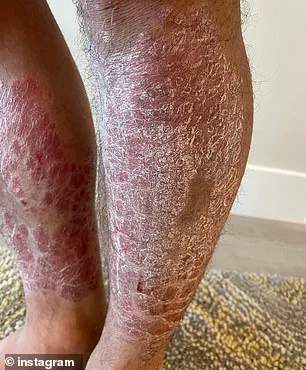 Chad Mendes' Struggle with Treatment-Resistant Plaque Psoriasis Highlights Need for New Approaches