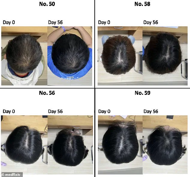 Groundbreaking Study from Taipei Reveals Centella Asiatica's Potential to Reverse Hair Loss with Novel Serum