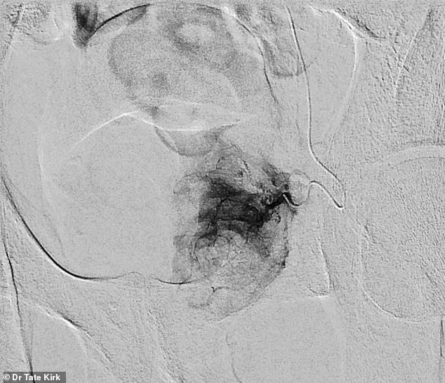 The Silent Crisis: Benign Prostatic Hyperplasia and Its Growing Impact on Men's Health