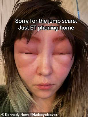 Urgent Warning: Severe Allergic Reaction After Eyebrow Tinting Sparks Safety Concerns
