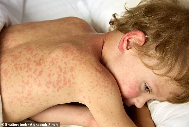 South Carolina Measles Outbreak: Clemson University Reports Positive Case, Emphasizes Isolation Protocols