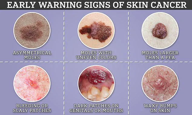 Beyond the Skin: Melanoma's Overlooked Signs and the Privileged Access to Early Detection