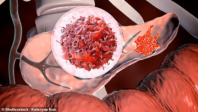 Breakthrough Blood Test May Transform Pancreatic Cancer Survival Rates Through Early Detection