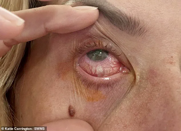 Nurse's Cautionary Tale: How Improper Contact Lens Use Led to Temporary Blindness