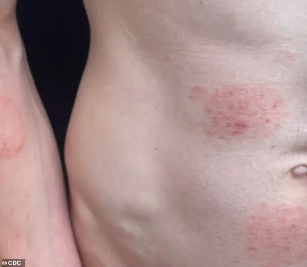 Minnesota Faces Largest Ringworm Outbreak in U.S. History