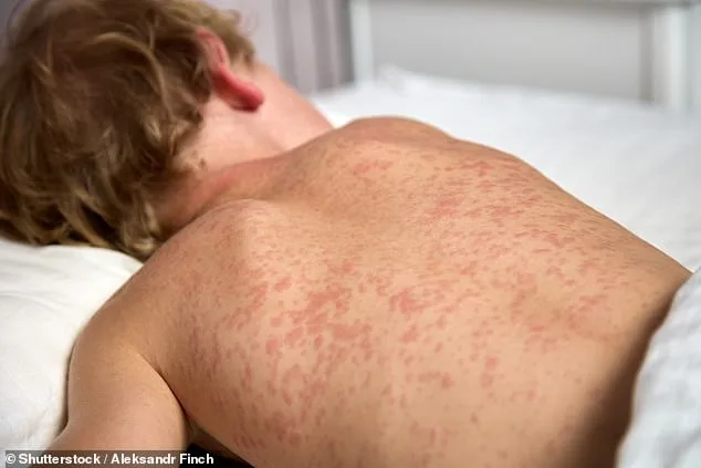 Public Health Crisis as Measles Exposure Rises in Utah Schools