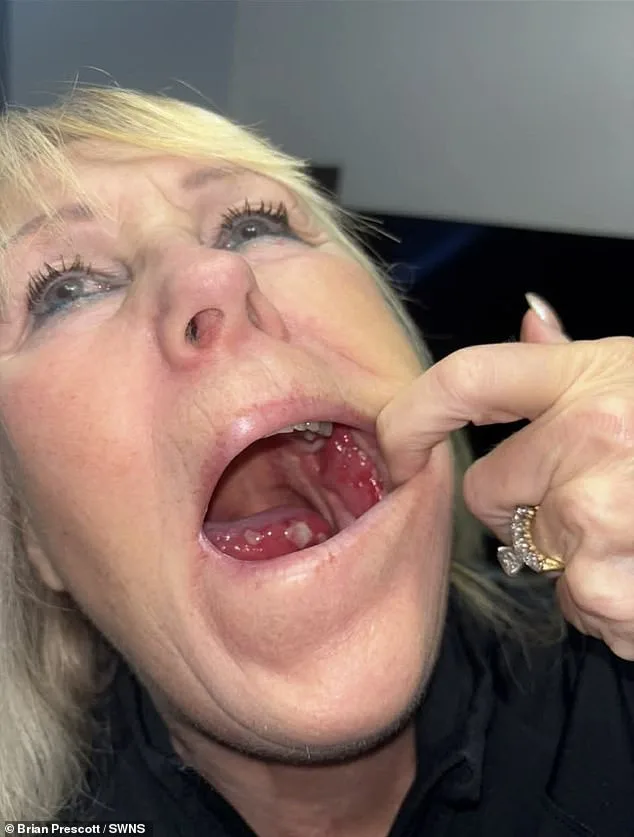 From Dismissed Ulcers to Tongue Cancer: A Harrowing Journey of Delayed Diagnosis