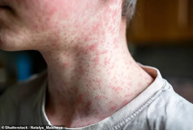 U.S. Measles Cases Surge to Nearly 1,000 in Two Months as South Carolina Becomes Epicenter