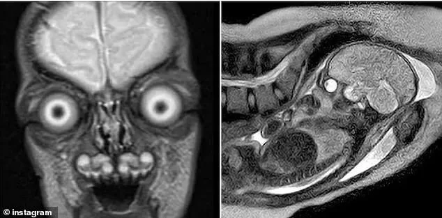 Resurfaced Fetal MRI Images Spark Debate Over Safety During Pregnancy