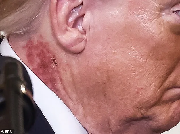Trump's Red Rash Sparks Health Speculation and Concern