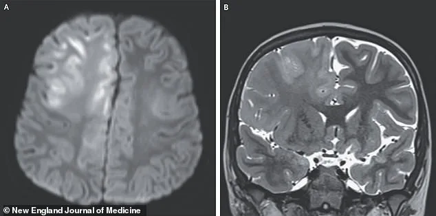 The Hidden Cost of Measles: SSPE Emerges as Silent Killer in South Carolina Outbreak