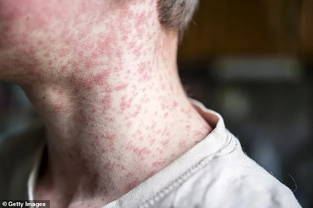 The Hidden Cost of Measles: SSPE Emerges as Silent Killer in South Carolina Outbreak