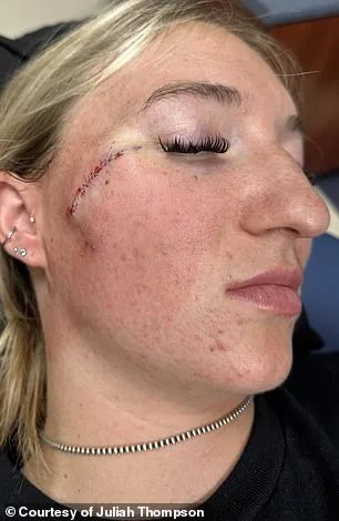 Juliah Thompson, 21, Ignores Mole That Transforms Over Three Months Despite Vigilant Skin Care