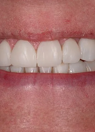 Confidence Reclaimed: Mandy Turver's Journey to a Brighter Smile After Overcoming Dental Anxiety