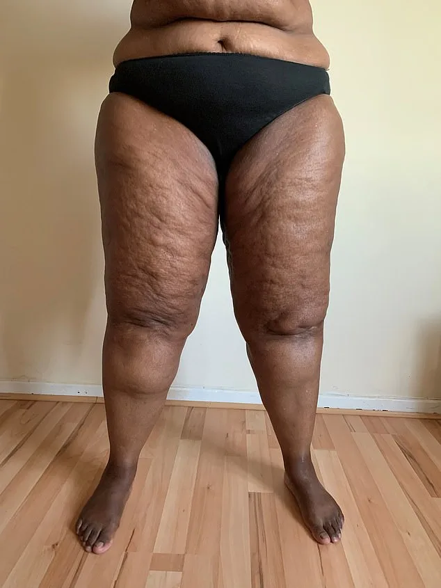 Lipoedema: The Hidden Condition Behind Celebrities' Stubborn Fat