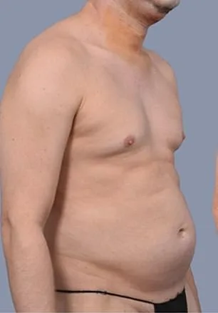 Frank Hoyle Spends $23,000 on Liposuction to Remove Stubborn Abdominal Pouch