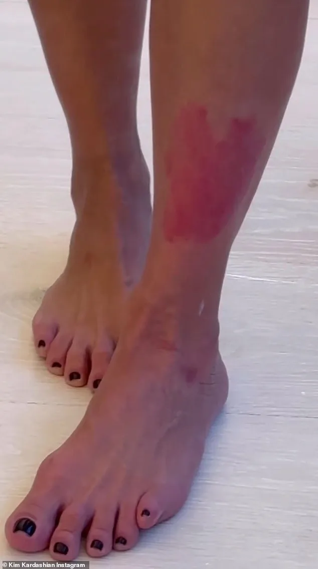 UK Psoriasis Crisis: Addressing Stigma, Misconceptions, and Mental Health Challenges