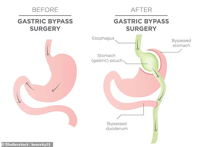 NHS Faces Surge in Weight-Loss Surgeries as Obesity Rates Climb
