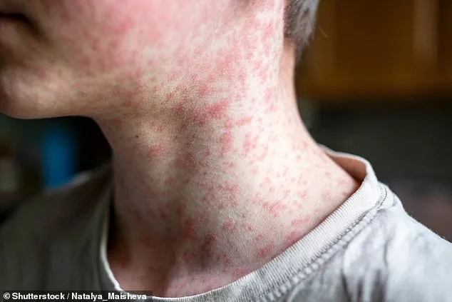 Measles Resurgence: US at Risk of Losing Elimination Status