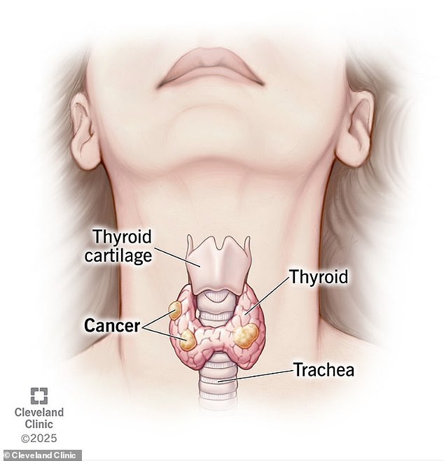 Dismissed by doctors, young man's hiccups reveal rising cancer epidemic.